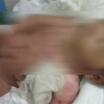 Alami Luka Bakar Serius, Seorang Bayi Asal Tubaba Butuh Bantuan Biaya Pengobatan