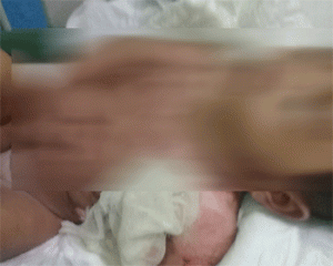 Alami Luka Bakar Serius, Seorang Bayi Asal Tubaba Butuh Bantuan Biaya Pengobatan